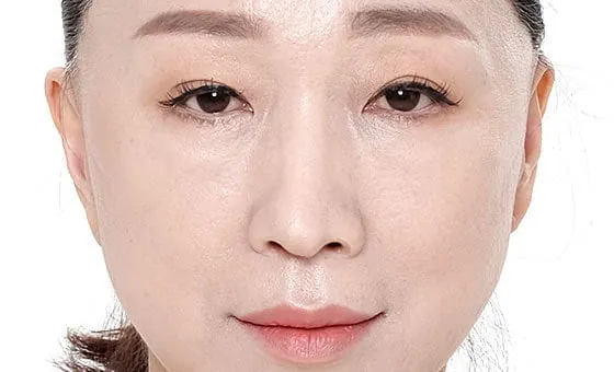 Mid-face lift after