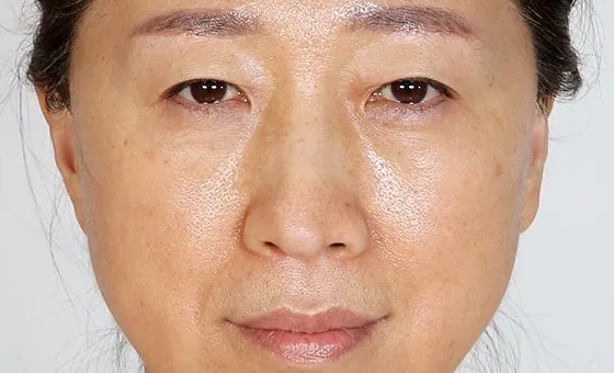 Mid-face lift before