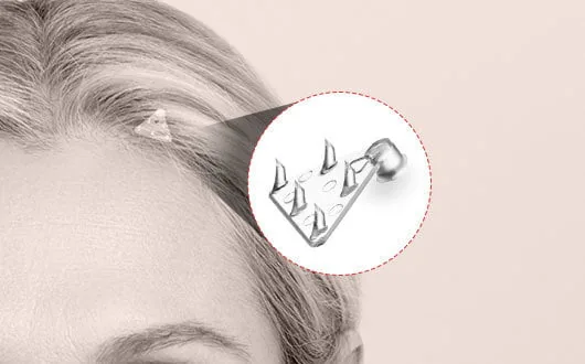 Illustration of an Endotine fixation implant positioned behind the hairline during a forehead lift