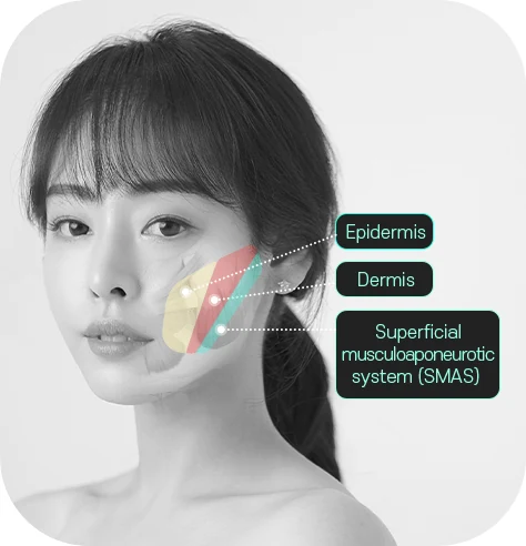 Diagram of the facial soft-tissue layers a thread lift works in: epidermis, dermis and the deeper SMAS layer