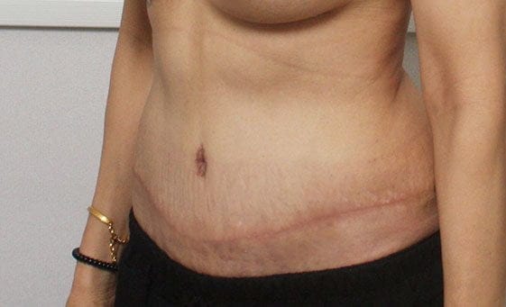 Body contouring surgery after