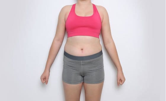 Body liposuction before