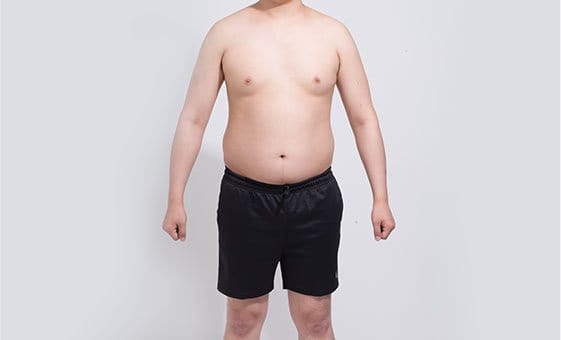 Body liposuction before
