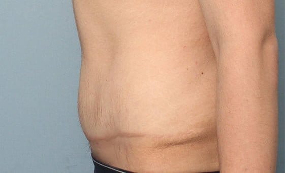 Body contouring surgery after