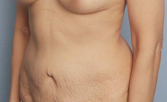 Body contouring surgery before